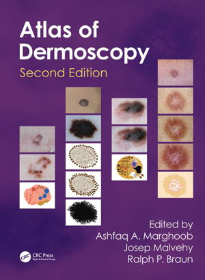 Cover art for An Atlas of Dermoscopy 2nd edition
