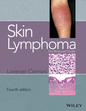 Cover art for Skin Lymphoma