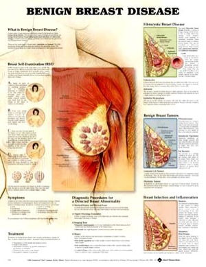 Cover art for Benign Breast Disease Anatomical Chart