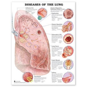 Cover art for Diseases of the Lung Anatomical Chart